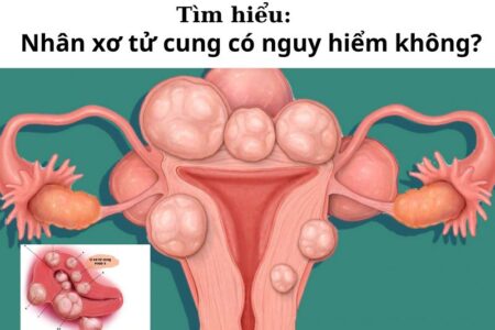 Nhân xơ tử cung có nguy hiểm không