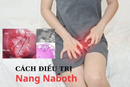 Cách điều trị nang naboth cổ tử cung