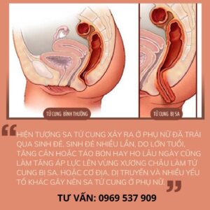 hiện tượng sa tử cung