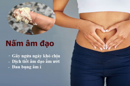 viêm nấm âm đạo