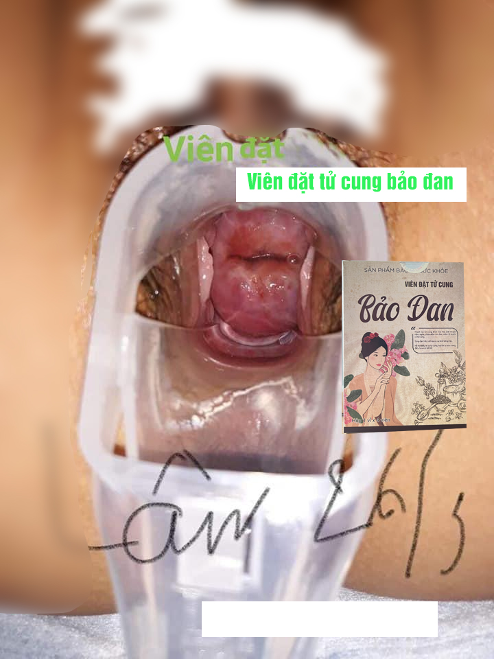 Chữa nang naboth bằng thuốc nam