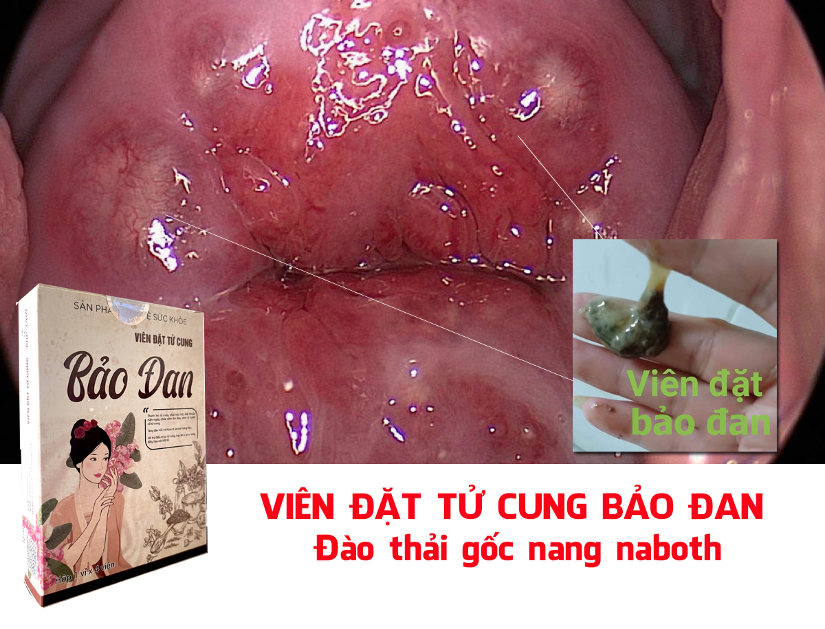 có nên đốt nang naboth