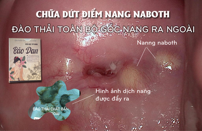 Chữa nang naboth bằng thuốc nam