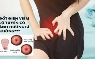 Đốt Điện Viêm Lộ Tuyến Có Ảnh Hưởng Gì Không