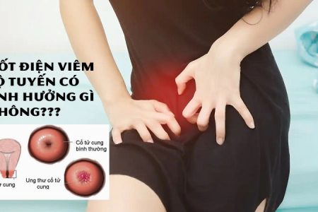 Đốt Điện Viêm Lộ Tuyến Có Ảnh Hưởng Gì Không