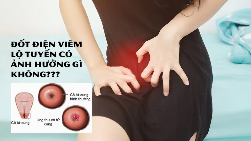 Đốt Điện Viêm Lộ Tuyến Có Ảnh Hưởng Gì Không