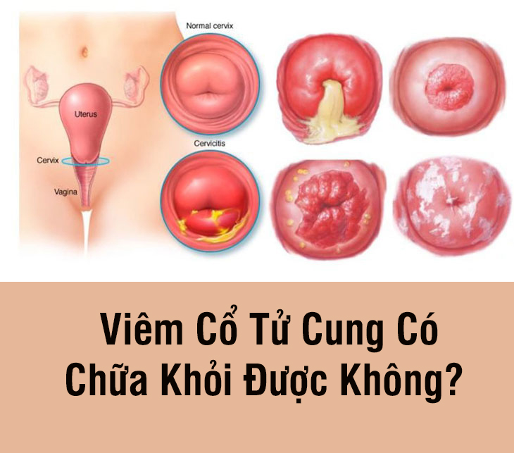 Đốt Điện Viêm Lộ Tuyến Có Ảnh Hưởng Gì Không